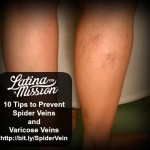 10 Tips to Prevent Spider Veins and Varicose Veins | LatinaOnaMission.com1